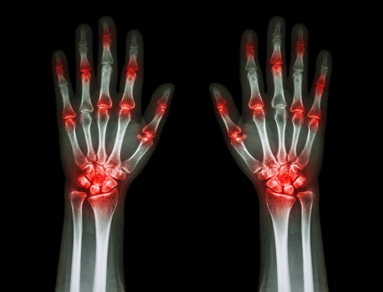 Hand Injuries - proActive Safety